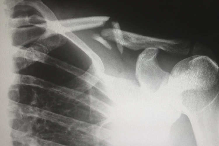 x-ray of broken bones