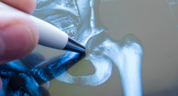 Hip joint implant prosthesis